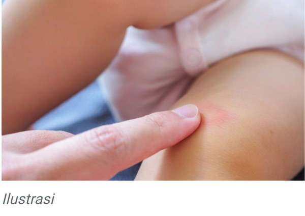 Waspadai, Sederet Gejala Awal Lupus pada Anak